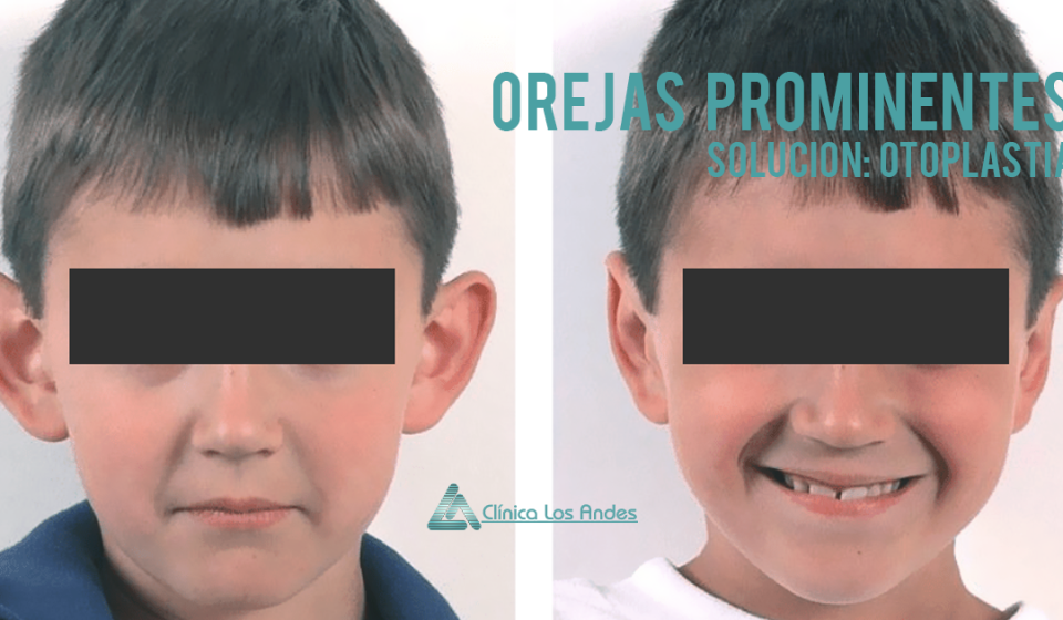 orejas de soplillo