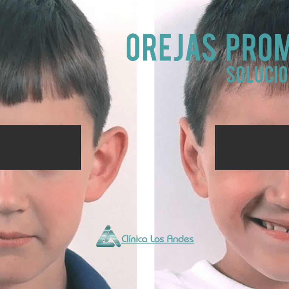 orejas de soplillo