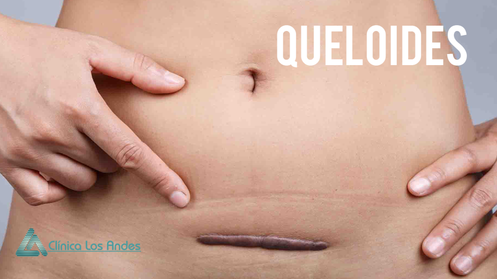 queloides