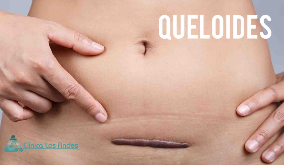 queloides
