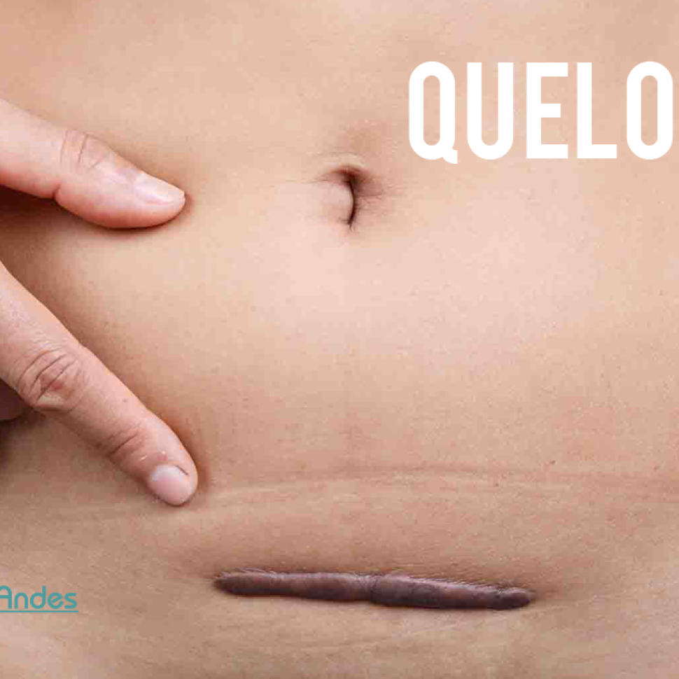 queloides